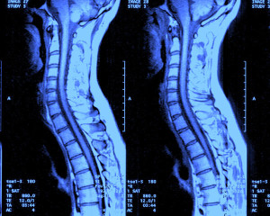 Mert a coloanei vertebrale, care este coloana vertebrală a coloanei vertebrale, pregătirea, contraindicațiile,