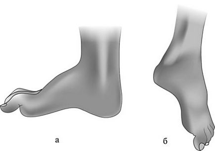 Neuropatia cauzelor nervului peroneal, simptomele și tratamentul, diagnosticul de la Kiev la