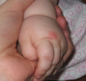 Copil nou-născut mușcat de mîini ce să facă