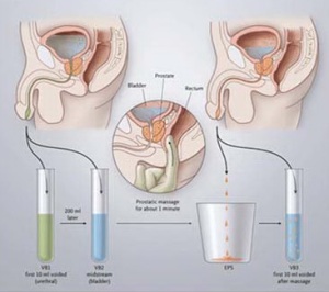 Simptome comune și locale ale prostatitei cronice