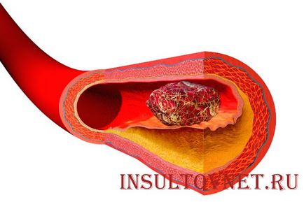 Amorteala in maini dupa un simptom de accident vascular cerebral si tratament - vii sanatosi