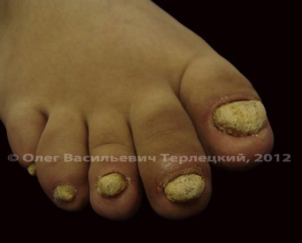 Onychomycosis sau micoza (ciuperca) de unghii