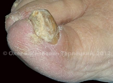Onychomycosis sau micoza (ciuperca) de unghii