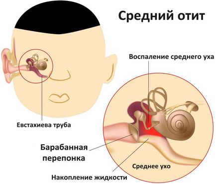 Szövődményei gennyes középfülgyulladás gyermekek és felnőttek, halláscsökkenés, meningitis