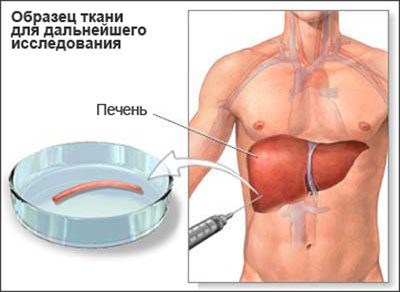 Distrofie hepatică toxică toxică acută toxică