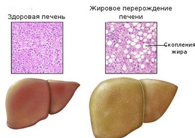 Distrofie hepatică toxică toxică acută toxică