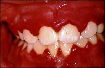 Гострий гінгівіт причини, симптоми і методи лікування