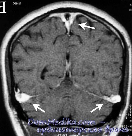 Tromboza acută a venelor și sinusurilor venoase ale creierului cauzează, diagnosticul, tratamentul