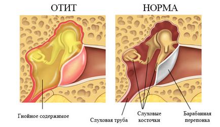 Középfülgyulladás felnőtteknél a tünetek és kezelések priichiny, megelőzés