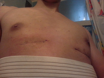 Відгук пацієнта Олега 25 років - хірургія лійкоподібної деформації грудної клітини