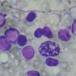 Paraproteinemic hemoblastoses - rákkezelés Izraelben, Izrael Cancer Center №1 (hematológiai betegségek) Paraproteinemic hemoblastoses - rákkezelés Izraelben, Izrael Cancer Center №1