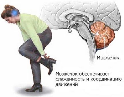 Patologii ale ataxiei cerebellar acute cerebrale