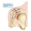Періартрит плечового суглоба лікування