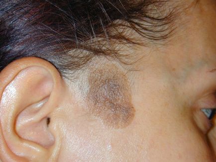 Cauzele și tratamentul pigmentării