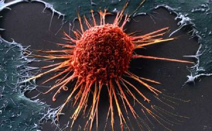 De ce a cauzat cancerul istoricul cancerului și alte informații