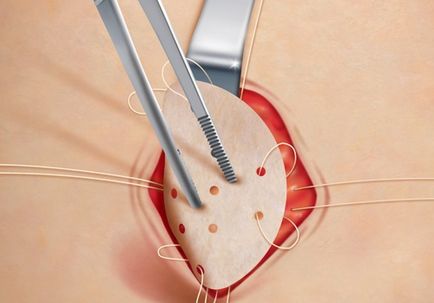 Hernia postoperatorie pe abdomen și căile de eliminare a acesteia