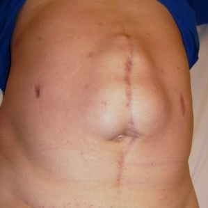 Hernia postoperatorie a abdomenului