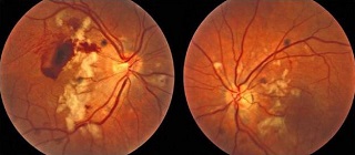 Retinopatia post-trombotică - diagnostic și tratament la Moscova la un preț accesibil