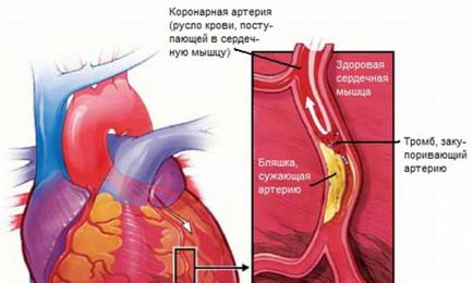 Infarctul miocardic repetat provoacă