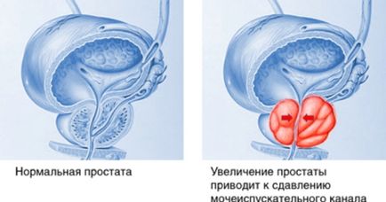 Cauzele prostatitei la bărbați