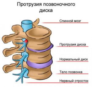 Protruziile coloanei vertebrale lombosacrale provoacă tratament