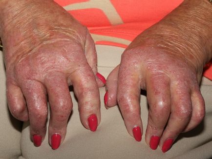 Tratamentul artritei psoriazice, simptome și fotografii