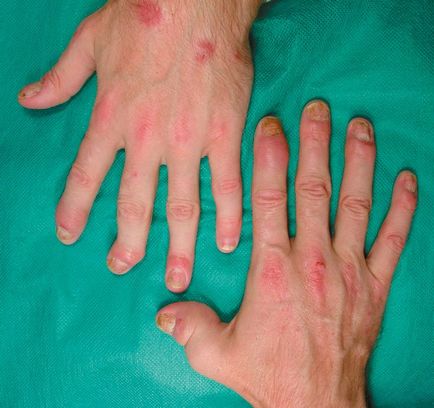 Az arthritis psoriatica kezelésére, a tünetek és a fényképek