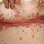 Psoriasis flexiós kezelésére felületek intim helyeken