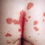 Psoriasis flexiós kezelésére felületek intim helyeken