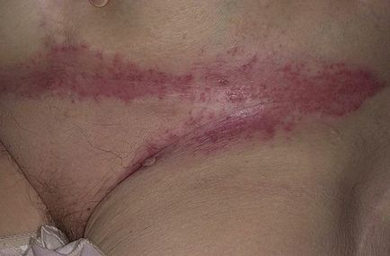 Psoriasis nőknél fotó, okok, tünetek, kezelés, ágyék