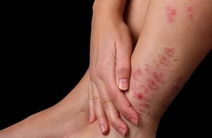 Psoriasis nőknél fotó, okok, tünetek, kezelés, ágyék