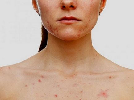 Psoriasis nőknél fotó, okok, tünetek, kezelés, ágyék