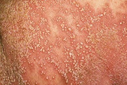 Psoriasis nőknél fotó, okok, tünetek, kezelés, ágyék