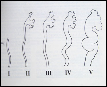 Chlamidia reflux