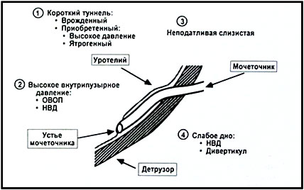 Міхурово-сечовідний рефлюкс