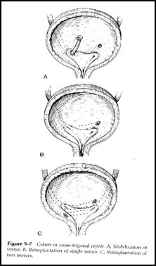 Chlamidia reflux