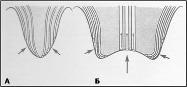 Chlamidia reflux