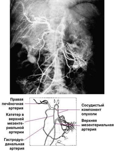 Metode radionuclidice de investigare și angiografie în diagnosticul bolilor pancreatice