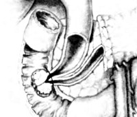 Cancerul papilei duodenale mari - cauze, simptome, diagnostic și tratament