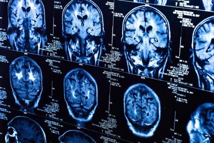 Simptomele și semnele de cancer la creier în stadiile incipiente