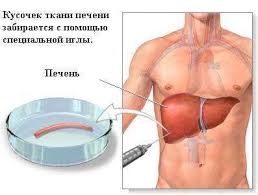 Clasificarea cancerului la ficat și simptomele, tratamentul și prevenirea cancerului