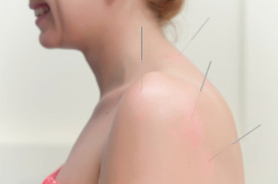 Reflexoterapie (acupunctura, acupunctura)