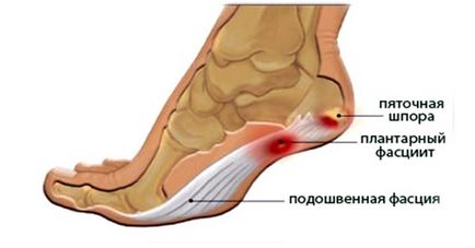 Raza radiologică a călcâiului (osul călcâiței) al bolțului, descrierea, tratamentul