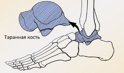 Raza radiologică a călcâiului (osul călcâiței) al bolțului, descrierea, tratamentul