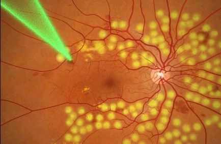 Retinopatia metodelor oculare de tratament, cauze și simptome