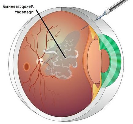 Retinopatia metodelor oculare de tratament, cauze și simptome