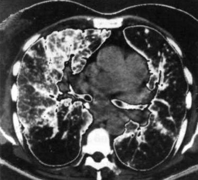 Результати торакоскопічної біопсії легені