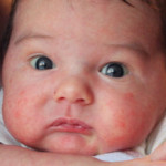 Rózsahimlő gyerekek tüneteinek és a fertőző időszak (fotó)