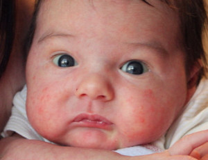 Розеола дитяча симптоми і заразний період (фото)