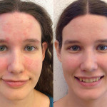 Себорея на обличчі лікування захворювання методами традиційної та народної медицини